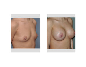 breast-implants-and-stretch-marks-result-oblique-view-dr-barry-eppley-indianapolis