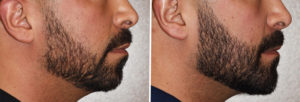 custom-jawline-implant-result-side-view-dr-barry-eppley-indianapolis