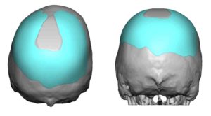 custom-skull-implant-for-skull-asymmetry-implant-design-back-view-dr-barry-eppley-indianapolis