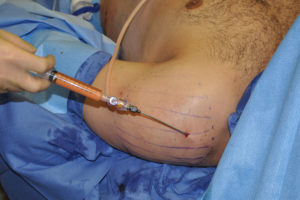 fat-injection-deltoid-augmentation-dr-barry-eppley-indianapolis