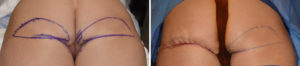 lower-buttock-lift-comparison-dr-barry-eppley-indianapolis