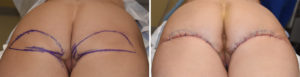 lower-buttock-lifts-intraop-result-dr-barry-eppley-indianapolis