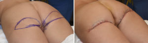 lower-buttock-lifts-intraop-result-oblique-view-dr-barry-eppley-indianapolis