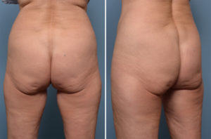 lower-buttock-sag-dr-barry-eppley-indianapolis