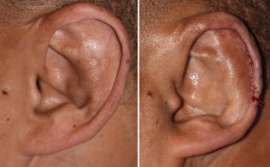 macrotia-reduction-left-ear-scaphal-flap-intraop-result-dr-barry-eppley-indianapolis