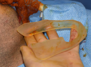 male-custom-jawline-implant-dr-barry-eppley-indianapolis