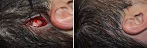 posterior-temporal-reduction-incision-dr-barry-eppley-indianapolis