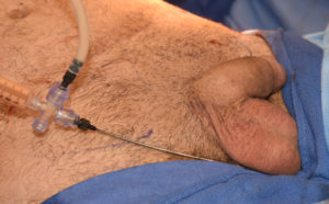 scrotal-enlargement-by-fat-injections-dr-barry-eppley-indianapolis