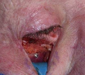 tear-trough-implants-screw-fixation