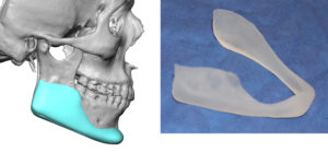 male-custom-jawline-implant-design-and-actual-implant-dr-barry-eppley-indianapolis