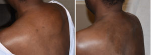 buffalo-hump-reduction-result-side-view-dr-barry-eppley-indianapolis