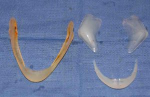 custom-jawline-implant-replacement-dr-barry-eppley-indianapolis