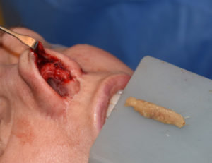 diced-rib-graft-rhinoplasty-dr-barry-eppley-indianapolis
