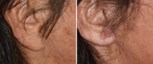 facelift-earlobe-reduction-result-side-view-copy