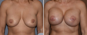 large-breast-implants-replacements-front-view-dr-barry-eppley-indianapolis