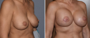 large-breast-implants-replacement-results-oblique-view-dr-barry-eppley-indianapolis