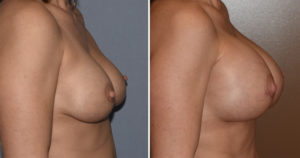 large-breast-implants-replacement-results-side-view-dr-barry-eppley-indianapolis
