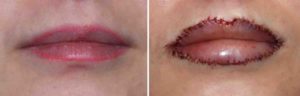 lip-advancements-for-lip-liner-removal-result-dr-barry-eppley-indianapolis