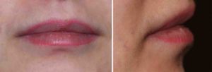 lip-liner-lips-before