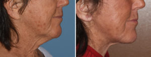 long-earlobe-facelift-result-side-view