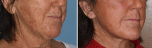 mvfacelift-result