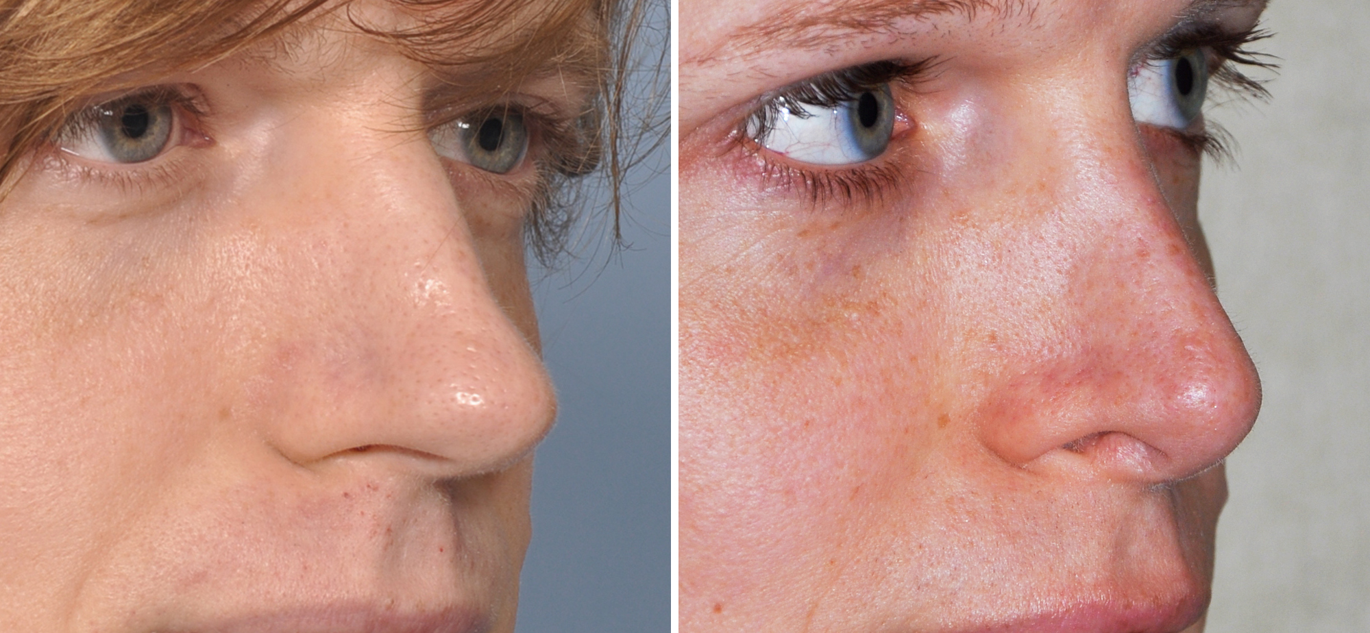 feminizations The Role of Rhinoplasty in Facial Feminization Surgery - Explore Plastic  Surgery