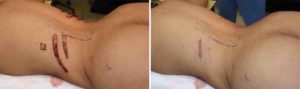 rib-removal-for-waistlione-narrowing-incision-dr-barry-eppley-indianapolis