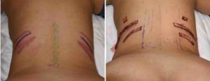 rib-removal-intraop-back-view-results