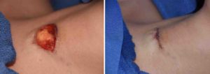 trach-scar-revision-with-dermal-fat-graft-dr-barry-eppley-indianapolis