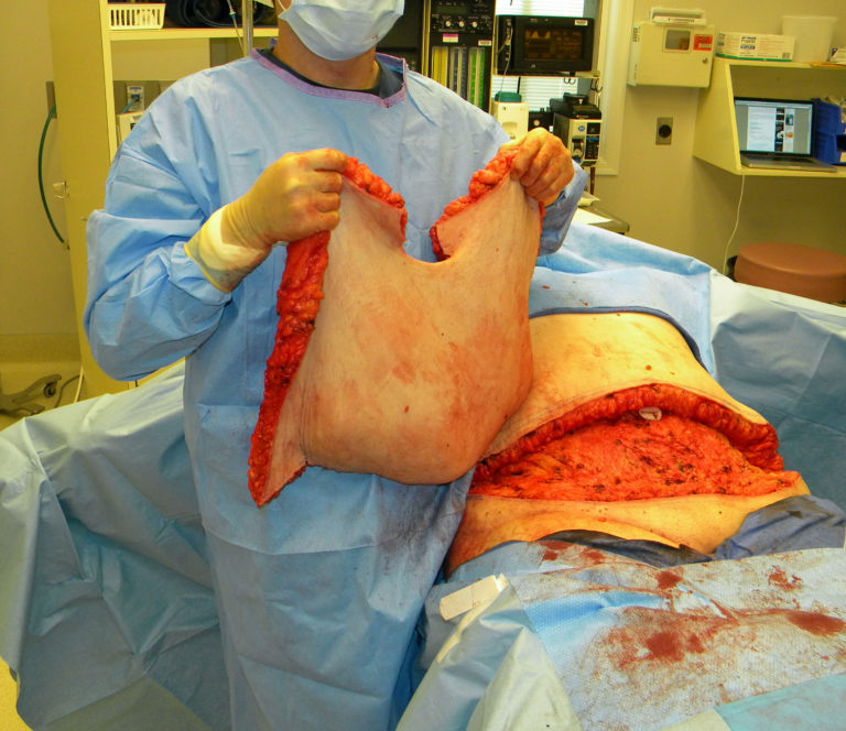 cpt code soft tissue mass excision cpt code soft tissue mass excision
