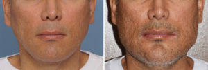 Custom Jawline Implant Replacement of Medpor Implant result front view Dr Barry Eppley Indianapolis