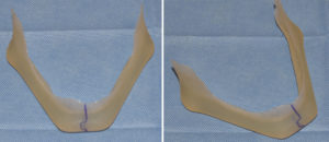 Custom Jawline Implant modification Dr Barry Eppley Indianapolis