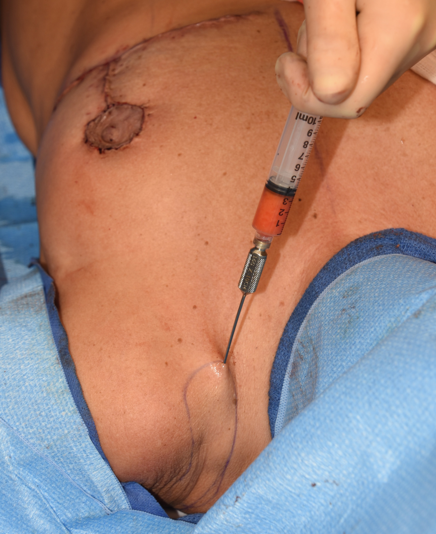 Shoulder Groove Fat Grafting in Breast Reduction Surgery - Explore Plastic  Surgery