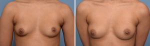 Fat Injection Breast Augmentation result front view Dr Barry Eppley Indianapolis