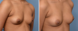 Fat Injection Breast Augmentation result obloque view Dr Barry Eppley Indianapolis