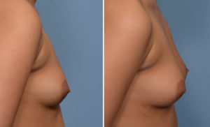 Fat Injectionk Breast Augmentation result side view Dr Barry Eppley Indianapolis