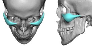 Malar-Arch Cheek Implant Design views 2 Dr Barry Eppley Indianapolis