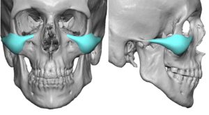 Malar-Arch Cheek Implant Desigtn Dr Barry Eppley Indianapolis