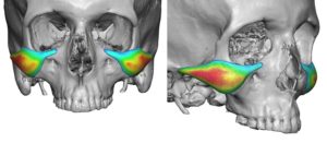 Malar-Arch Cheek Implant design color mapping Ddr Barry Eppley Indianapolis