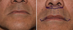 Male Subnasal Lip Lift and Corner of the Mouth Lifts drawings Dr Barry Eppley Indianapolis