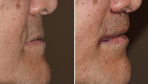 Male Subnasal Lip Lift and Corner of the Mouth Lifts immediate result Dr Barry Epley Indianapolis