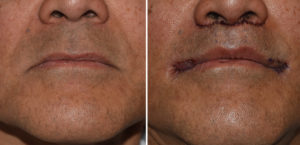 Male Subnasal and Corner of Mouth Lifts immediate result Dr Barry Eppley Indianapolis