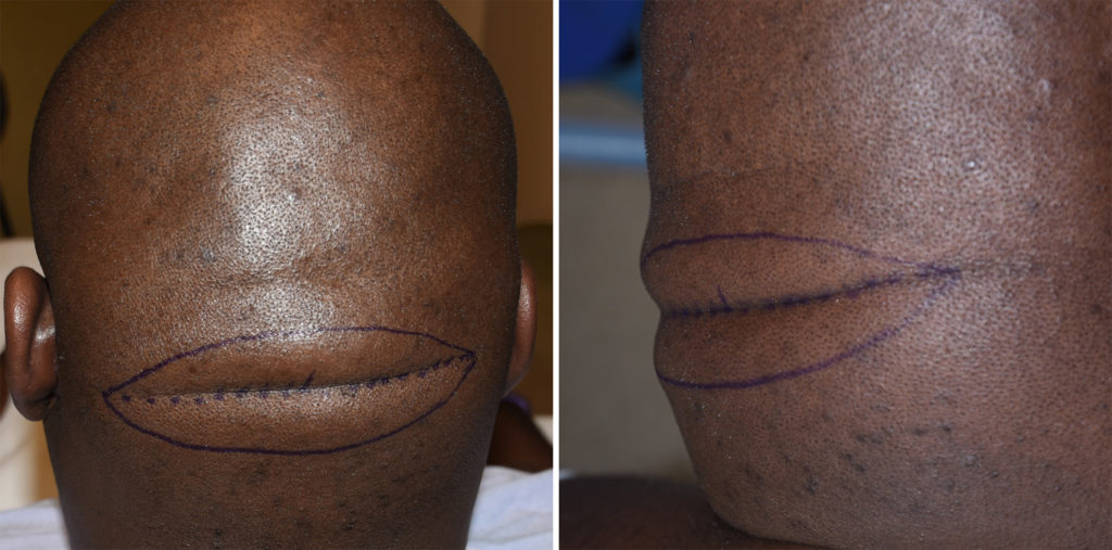 Plastic Surgery Case Study Occipital Scalp Roll Excision Explore