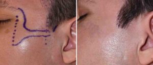 Posterior Zygomatic ASrch Incision Healing Dr Barry Eppley Indianapolis