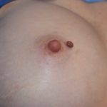 supernumerary-nipple-next-to-augmented-breast-dr-barry-eppley-indianapolis