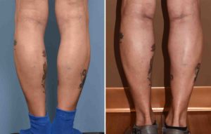 Upper Inner Calf Implants result back view Dr Barry Eppley Indianapolis