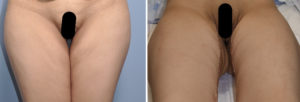 vertical inner thigh lift gap result Dr Barry Eppley Indianapolis