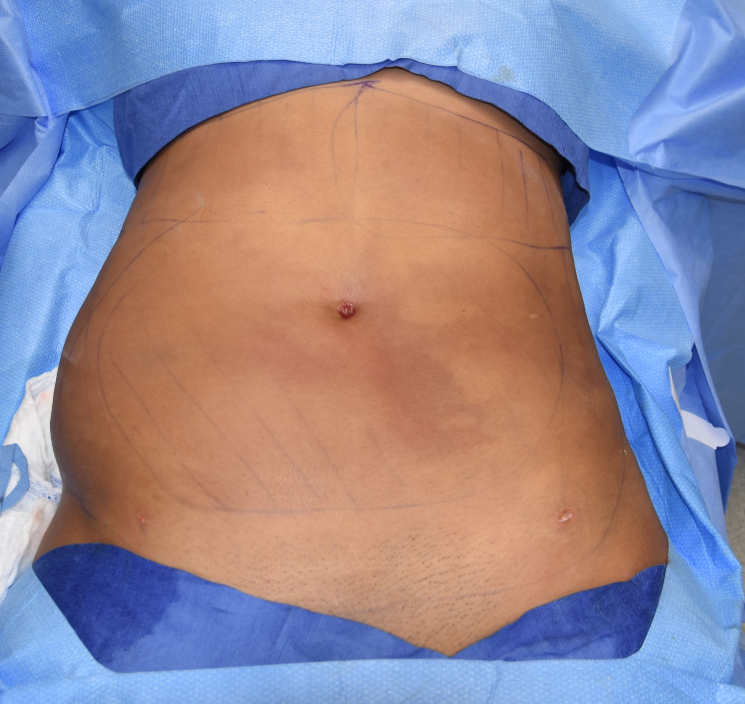 OR Snapshots - Abdominal and Flank Liposuction - Explore Plastic
