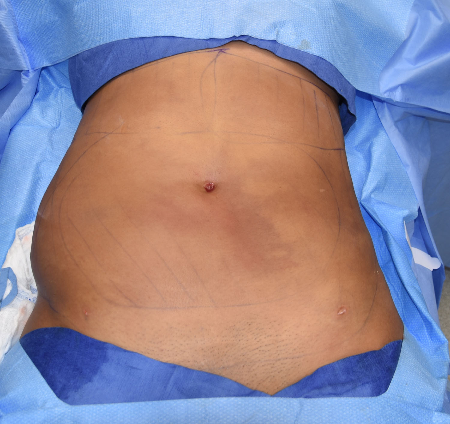 OR Snapshots - Abdominal and Flank Liposuction - Explore Plastic Surgery