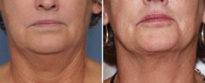 CA Neck Liposuction result front view